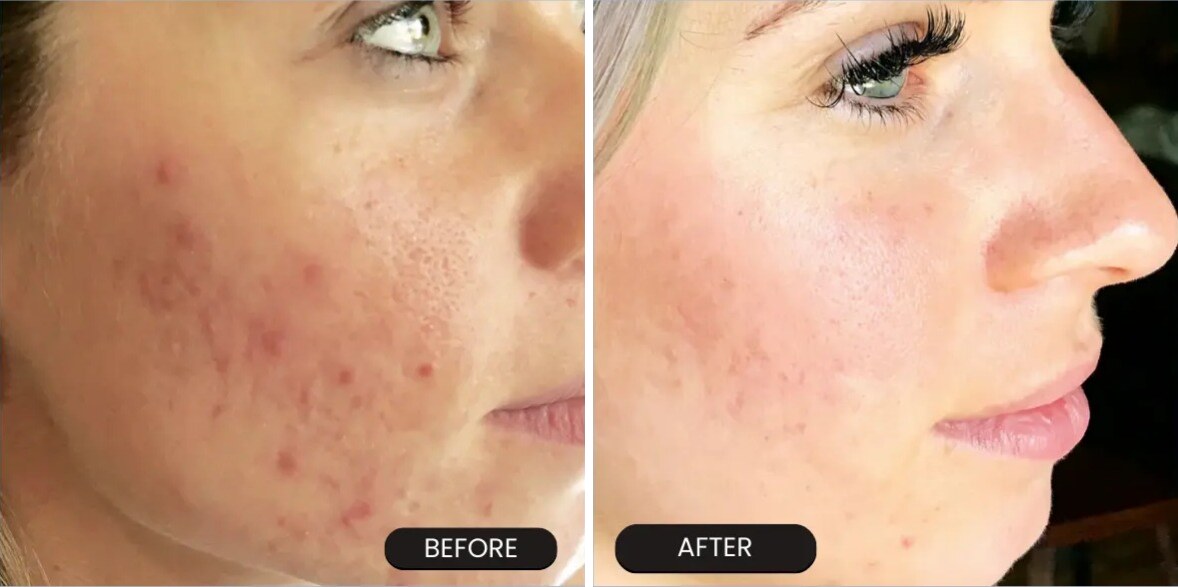 VI Peel Before & After Image