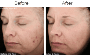 Vitalize Peel Before & After Image